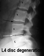 Lumbar Traction indicated for Degenerative Discs
