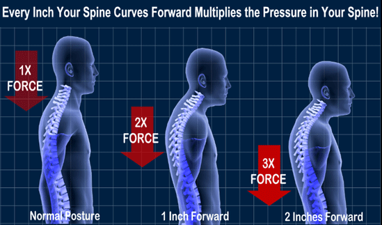 Slouching, widows hump, AGS or Poor Posture?