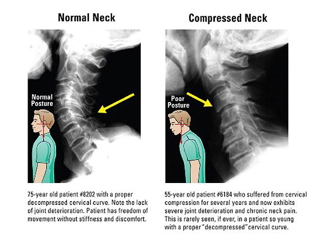 Neck X-rays of Before and After Result with Posture Pump