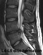 Lumbar Traction for Disc Herniation