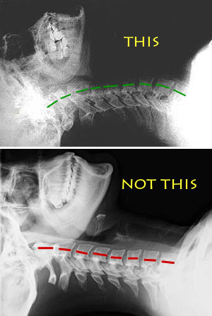Before & After X-ray of cervical spine with support from Sissel Orthopedic Neck Pillow 